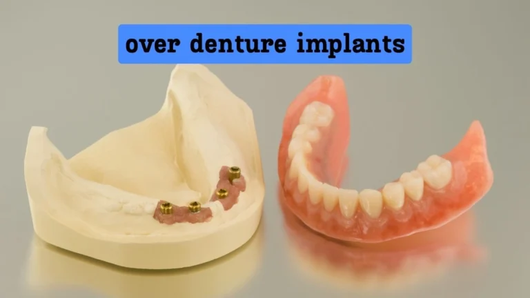 over denture implants